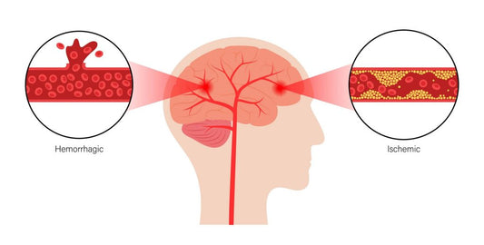 Understanding Stroke Symptoms: Recognizing the Signs Can Save Lives